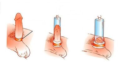 The principle of pump operation to increase penis