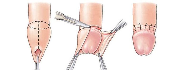The effect of circumcision on penis size