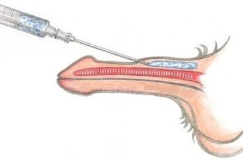 A dangerous method of penis enlargement with petroleum jelly injections